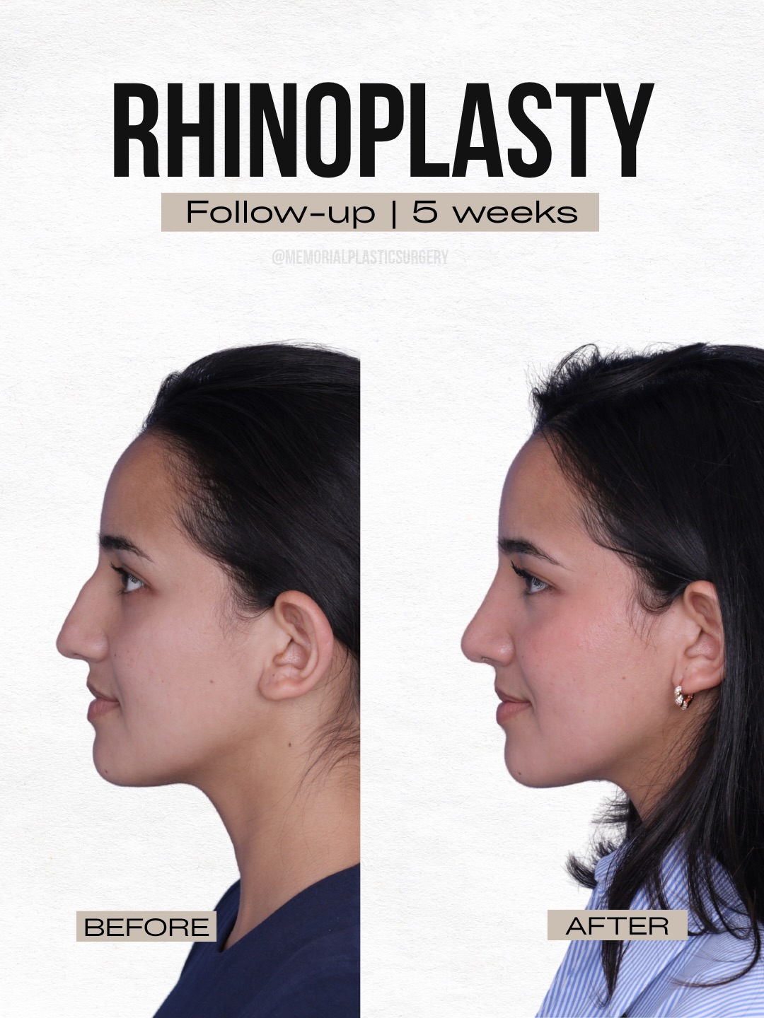 5 weeks out — still swollen, still settling 👃🏼
And already looking like it was always supposed to be there.
She came in with cosmetic concerns and some left-sided obstruction. We addressed both — the profile, the tip, and the breathing — in one surgery.
The swelling is still resolving. The tip will continue to refine over the next several months. But even at 5 weeks, the nose already looks like hers. And on top of it all, breathing is a night and day difference.
That’s the goal every single time.
Procedure(s) performed:
🔹 Rhinoplasty
🔹 Open septorhinoplasty
🔹 Turbinate reduction
Questions below 💬
📍 @memorialplasticsurgery | #houstonplasticsurgeon