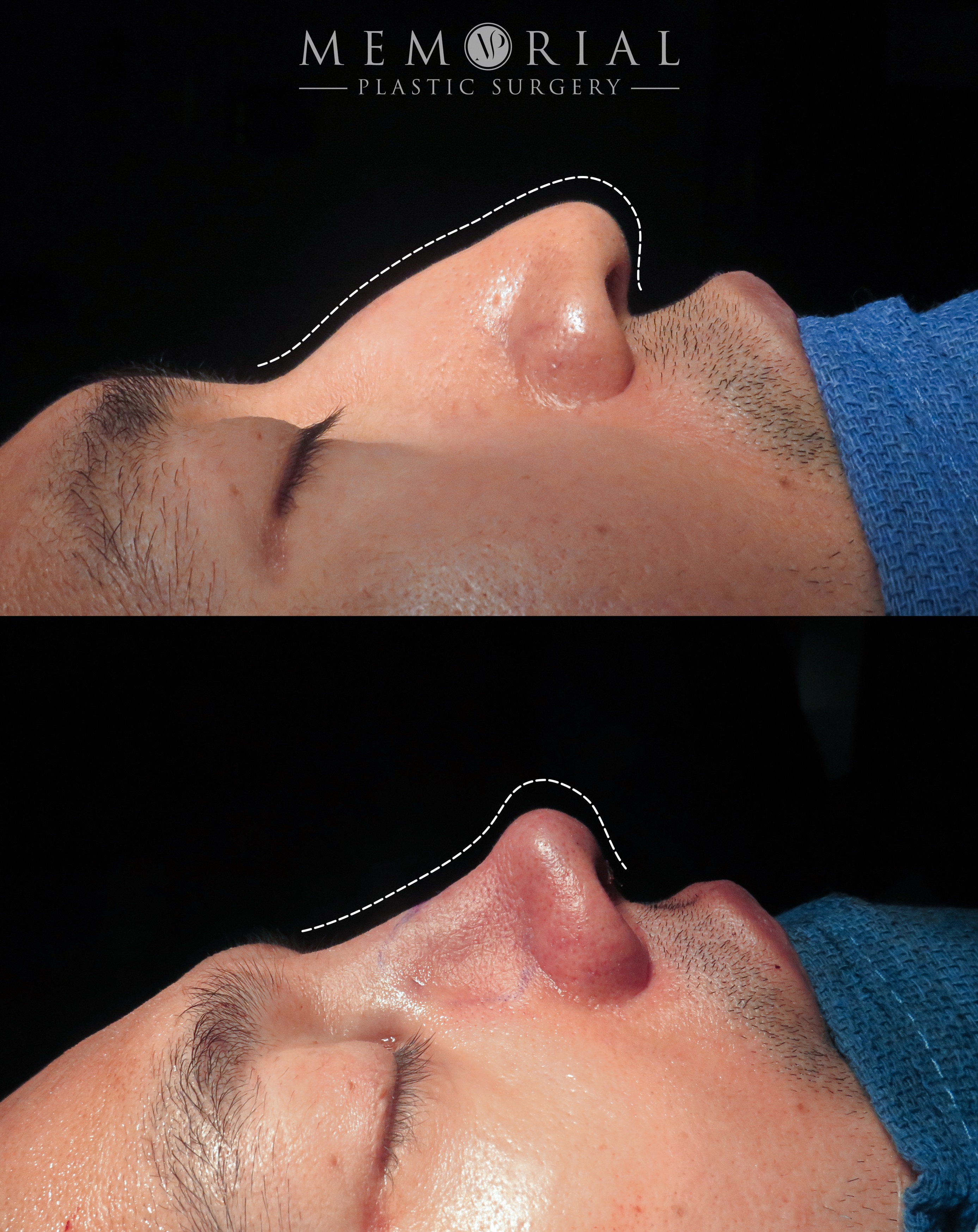 Fresh off the table. 👃🏻
This one had a few curveballs — a previous septoplasty with a fractured anterior septal angle that required near complete reconstruction before we could even get to the cosmetic work.
Not just reshaping. Rebuilding from the foundation up to make a stronger and more refined nose.
Procedure(s) performed:
🔹 Open septorhinoplasty
🔹 Septal reconstruction
Questions below 💬
📍 @memorialplasticsurgery | #houstonplasticsurgeon